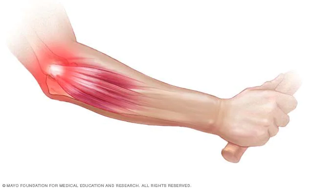 causes of Tennis Elbow